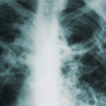 X-ray of a human chest showing ribs, spine, and shoulder bones.
