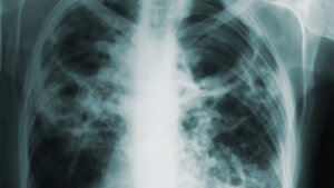X-ray of a human chest showing ribs, spine, and shoulder bones.